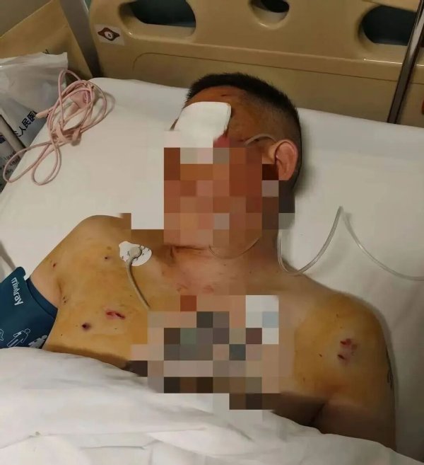 股票配资佣金 男子取170万在银行门口遭抢，致一眼失明！银行回应